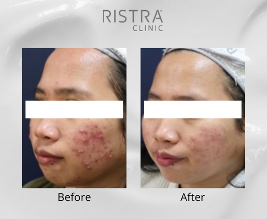Acne & Comedo